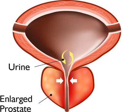 Diagramma – prostata ingrossata (IPB)
