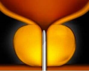 Fase 1 del sistema UroLift