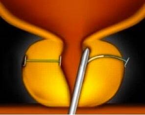 Fase 2 del sistema UroLift