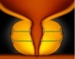 Fase 3 del sistema UroLift